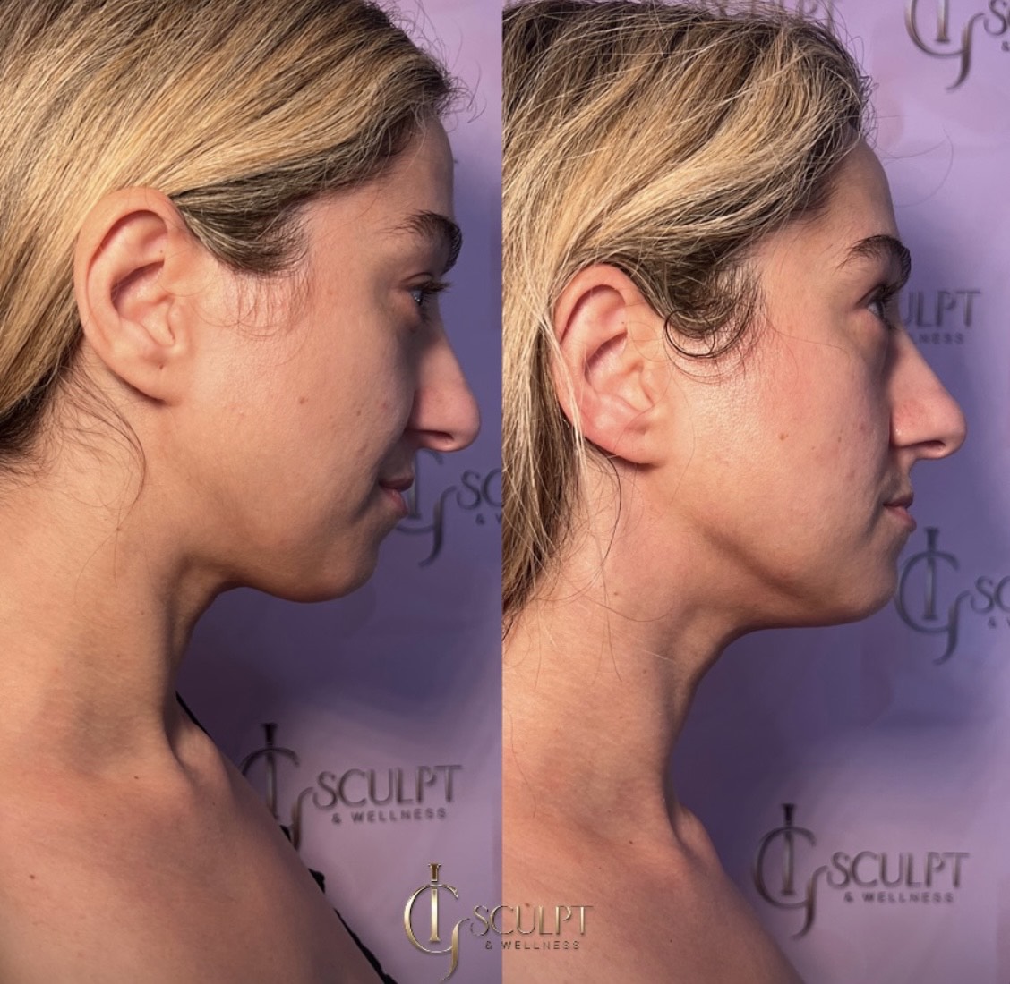 Before and after: Face Sculpt