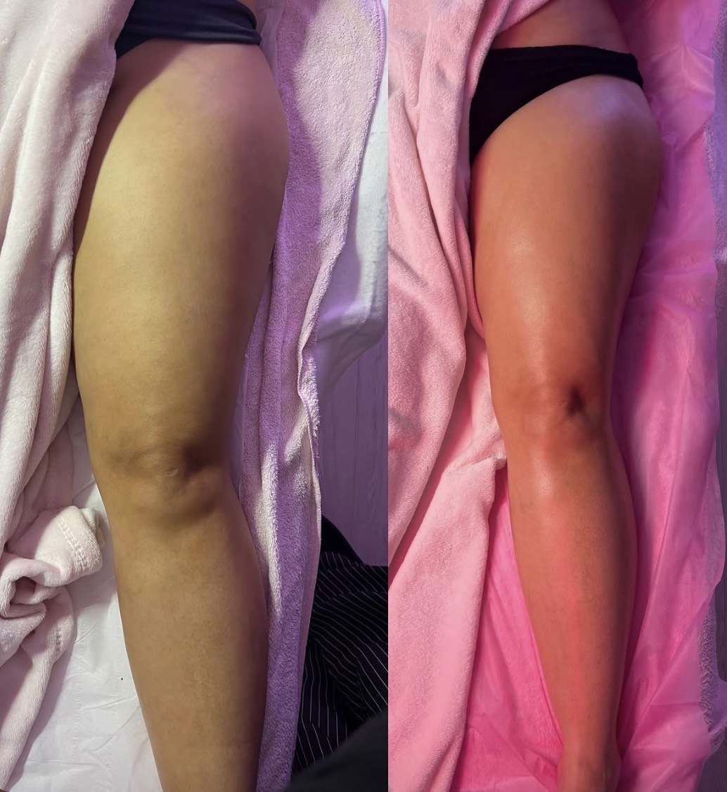 Before and after: Manual Lymphatic Drainage
